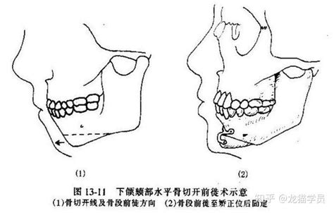 下巴中央凹陷